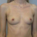 Breast Augmentation Case 48 Before