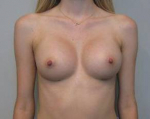 Breast Augmentation Case 48 After