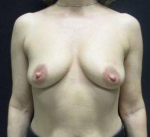 Breast Augmentation Case 49 Before