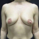 Breast Augmentation Case 49 Before