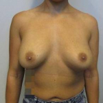 Breast Augmentation Case 50 Before