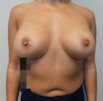 Breast Augmentation Case 50 After