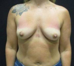 Breast Augmentation Case 51 Before