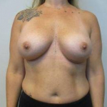 Breast Augmentation Case 51 After
