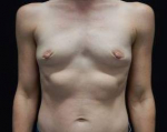 Breast Augmentation Case 52 Before