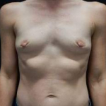 Breast Augmentation Case 52 Before