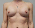 Breast Augmentation Case 52 After