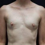Breast Augmentation Case 55 Before