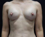 Breast Augmentation Case 55 After
