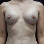 Breast Augmentation Case 55 After