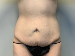 31yo Female Abdominoplasty Before