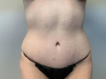 31yo Female Abdominoplasty After