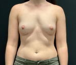 38yo female Breast Augmentation Before