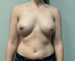 38yo female Breast Augmentation After