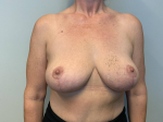 Breast Lift 42 Year Old Female After