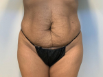 Tummy Tuck 36 year old female Before