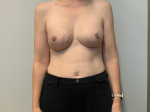 58 Year Old Female Breast Reconstruction after Mastectomy After