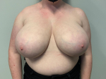 34 Year Old Female Breast Reduction Before