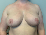 34 Year Old Female Breast Reduction After