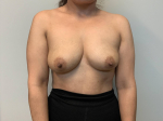 46 Year Old Female Breast Reduction and Breast Lift Before