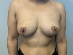 46 Year Old Female Breast Reduction and Breast Lift After