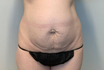 Mommy Makeover - breast augmentation, abdominoplasty Before
