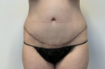Mommy Makeover - breast augmentation, abdominoplasty After