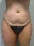 CoolSculpting Case 1 Before