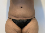49 year old female, abdominoplasty After