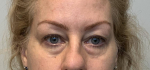 47 year old female, upper and lower blepharoplasty Before