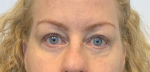 47 year old female, upper and lower blepharoplasty After