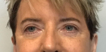 66 year old female, lower blepharoplasty After