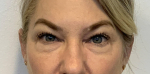 50 year old female, upper and lower blepharoplasty Before