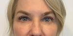 50 year old female, upper and lower blepharoplasty After