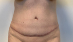 50 year old female, abdominoplasty After