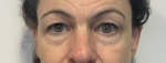 52 year old female, lower blepharoplasty Before