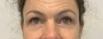 52 year old female, lower blepharoplasty After