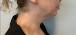 52 year old female, deep necklift Before