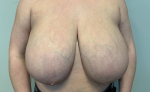 27 year old female, breast reduction with free nipple graft Before
