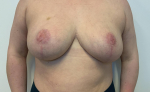 27 year old female, breast reduction with free nipple graft After