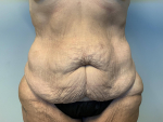 42 year old female, abdominoplasty Before