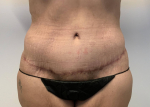 42 year old female, abdominoplasty After