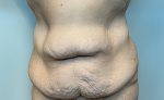 46 year old female, abdominoplasty Before