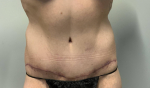 46 year old female, abdominoplasty After