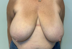 63 year old female, oncoplastic closure with breast reduction for symmetry Before