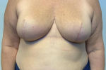63 year old female, oncoplastic closure with breast reduction for symmetry After