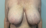 66 year old female, breast reduction Before