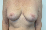66 year old female, breast reduction After