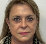72-year-old female, facelift, lower blepharoplasty, lateral temporalplasty After