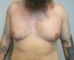 Male Breast Reduction Case 3 Before